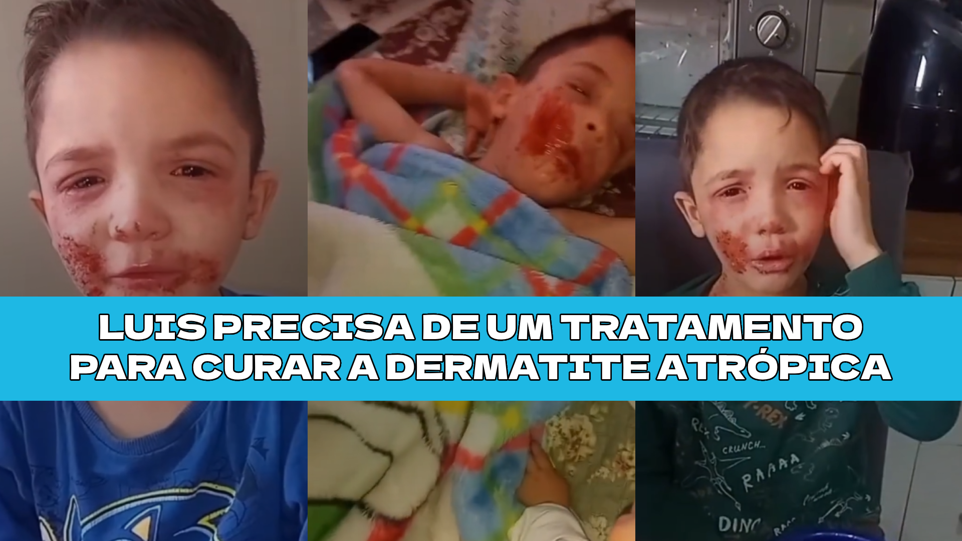 Cura para Luis - Dermatite Atrópica